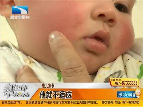 为何冬季宝宝湿疹会高发 宝宝得了湿疹怎么办