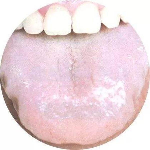 舌苔厚白有中成药治吗？