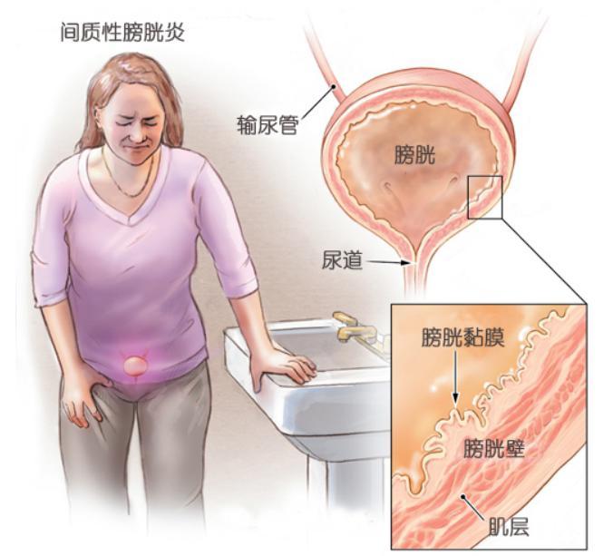 饮食在间质性膀胱炎膀胱疼痛综合征中的作用