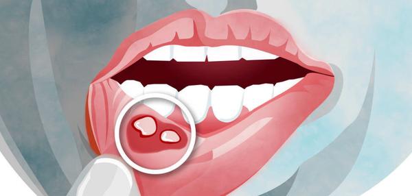 口腔溃疡的治疗方法 经常口腔溃疡怎么办？