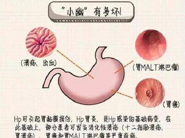 幽门螺旋杆菌是什么原因引起的(胃幽门螺旋杆菌感染是怎么回事)