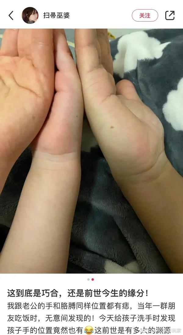 听说缘分断了手上会长痣(手忽然长痣)