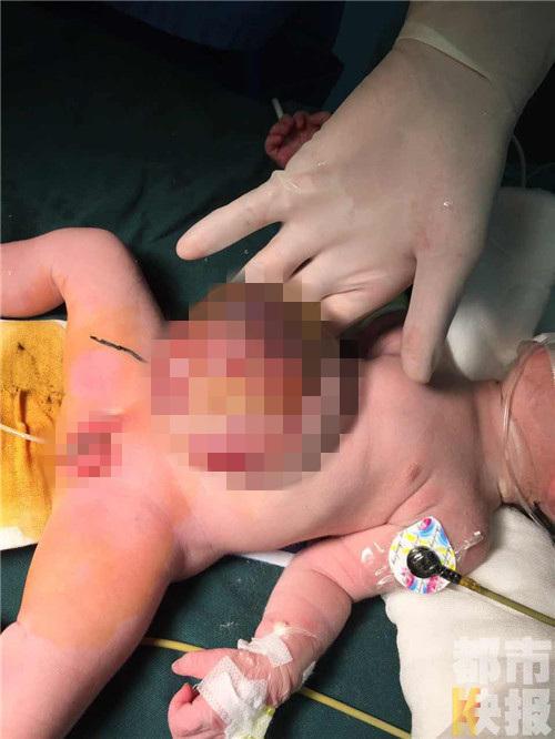出生仅3天女婴患巨大脐膨出 肝脏等多器官长体外