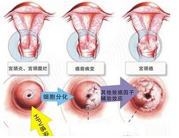 感染HPV有多大几率得宫颈癌？