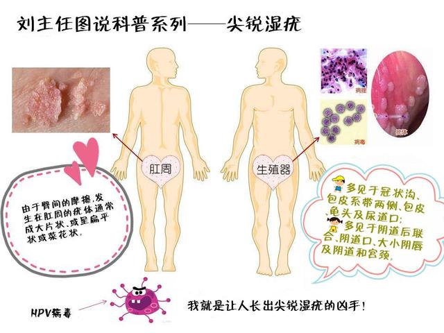 一张图教你识别尖锐湿疣