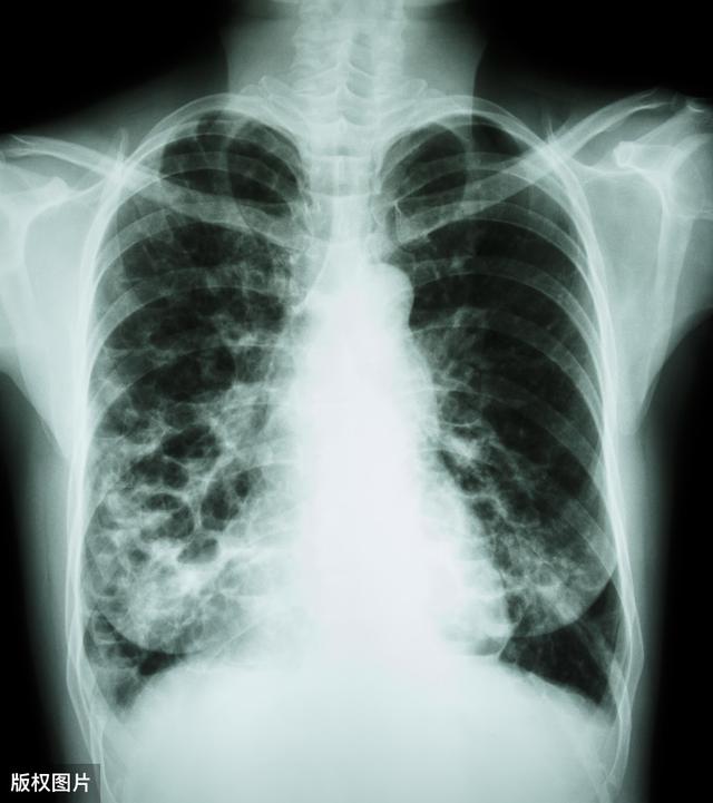 新型肺炎面前，抵抗力强就是“王者”，增强抵抗力5种方法，推荐