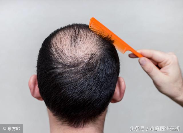 男人秃顶的5个原因，你知道几个？早点了解还能预防