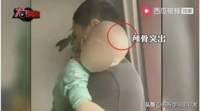 “大头娃娃”阴霾12年不散，别让三聚氰胺的噩梦卷土重来