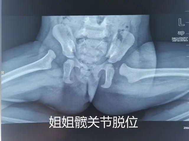 始料未及!一家俩先髋儿,不可侥幸避筛查,髋关节发育不良需早治