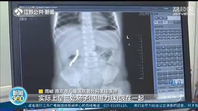 儿童误吞磁力珠进了ICU 医生：肠子吸在一起，几乎排不出来