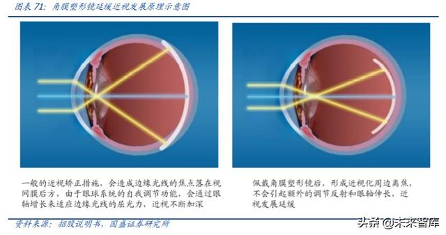 爱博医疗深度解析：专注创新的眼科器械龙头企业