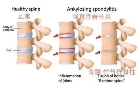 困扰周杰伦的强直性脊柱炎，到底是什么病？骨科医生专业角度分析