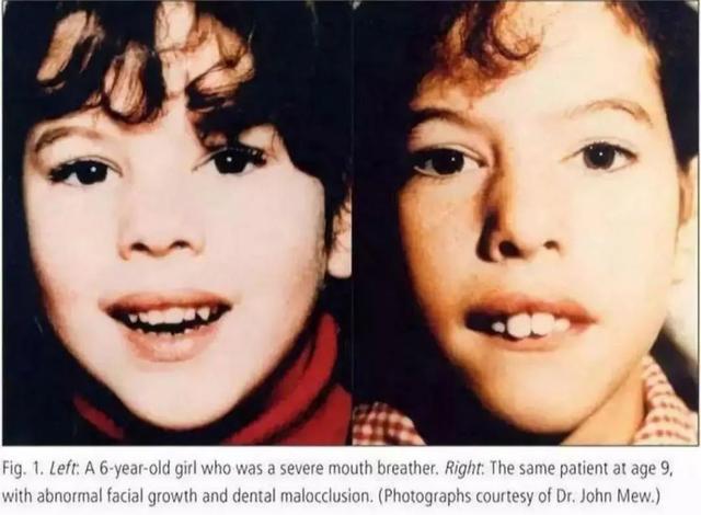 你知道吗？口呼吸可能会让孩子变成龅牙