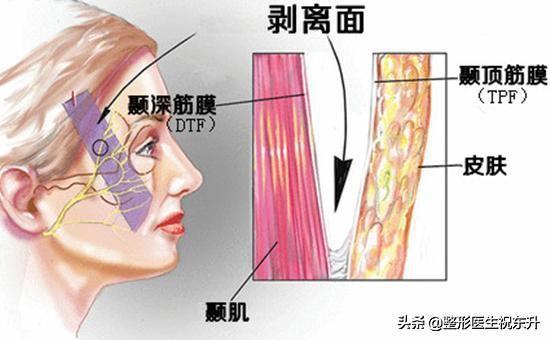 做拉皮手术，您所关心的事：术后疼不疼？不戴头套可以吗？后遗症