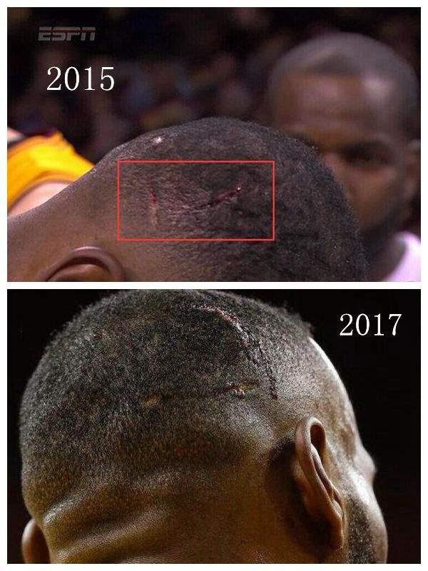 在NBA成功有多不容易？詹姆斯頭部傷痕明顯，科比傷病圖令人動容