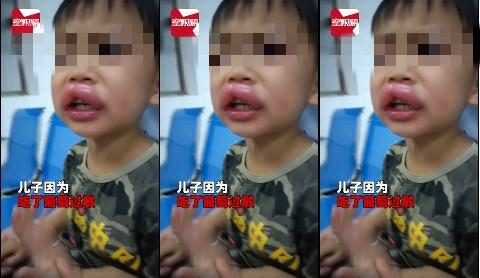 嘟嘟|吃葡萄肿成嘟嘟嘴 孩子父亲表示虽然心疼但还是忍不住想笑