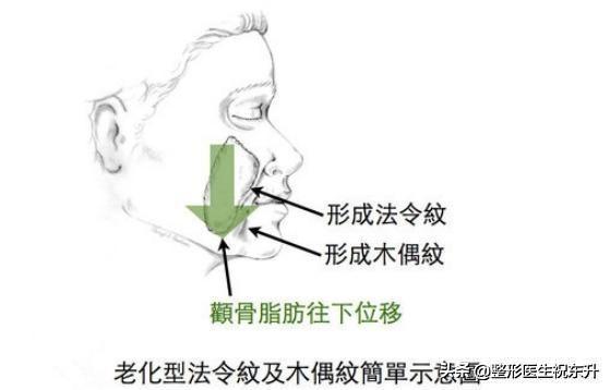 脸上有法令纹，最直观的感受就是：显老！医生给你支个招