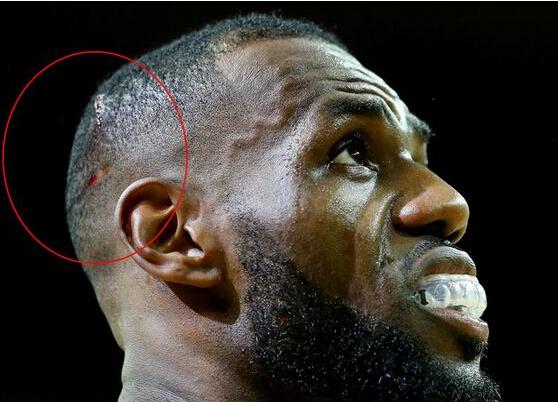 NBA球星的傷疤：羅斯的膝蓋 科比的跟腱 詹姆斯的頭部