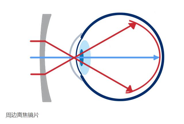 远视离焦是什么意思(远视性离焦理论)