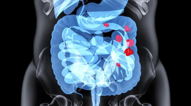 食物导致宝宝肠道过敏，该怎么办？