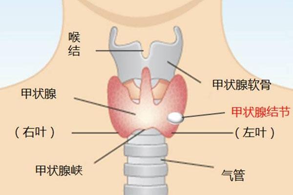 什么是“甲状腺结节”？如何才能有效避免结节“病变”?