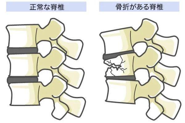 为了美白日本小姐姐常年全面防晒！却为此差点全身瘫痪…