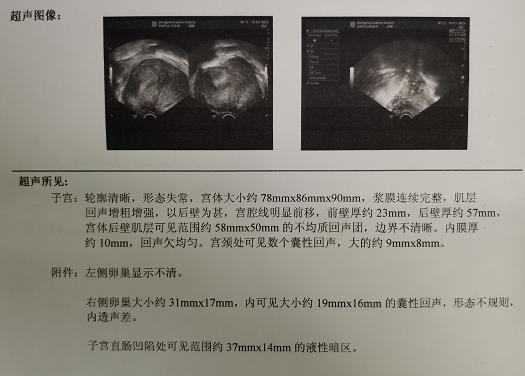 正确诊断腺肌症，从这几方面着手