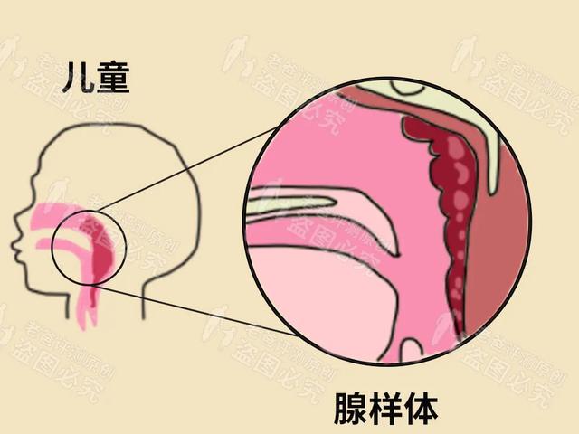 你知道吗？口呼吸可能会让孩子变成龅牙