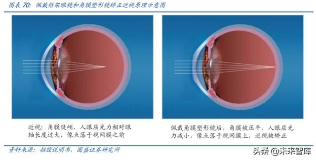 爱博医疗深度解析：专注创新的眼科器械龙头企业