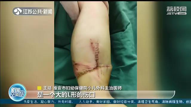 好危险！两岁男童误启电动车 翻车缝了近60针