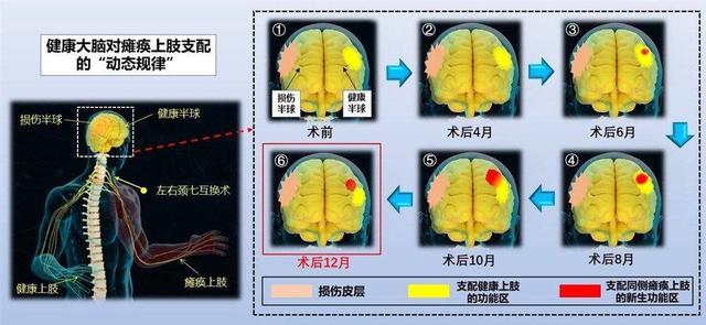中枢性偏瘫治疗取得突破 中国信号系统方案“走
