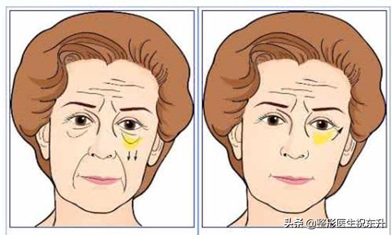 做完祛眼袋手术6天，朋友都说前、后差别很大，年轻了5~10岁