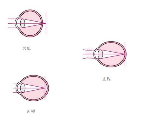 2岁娃近视900度，根本原因不在手机，远视储备了解一下