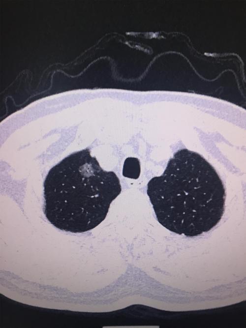 发现肺部结节，能不能吃海鲜？饮食注意什么—肺部结节科普