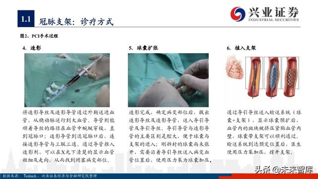医疗器械之冠脉支架行业深度研究与投资策略