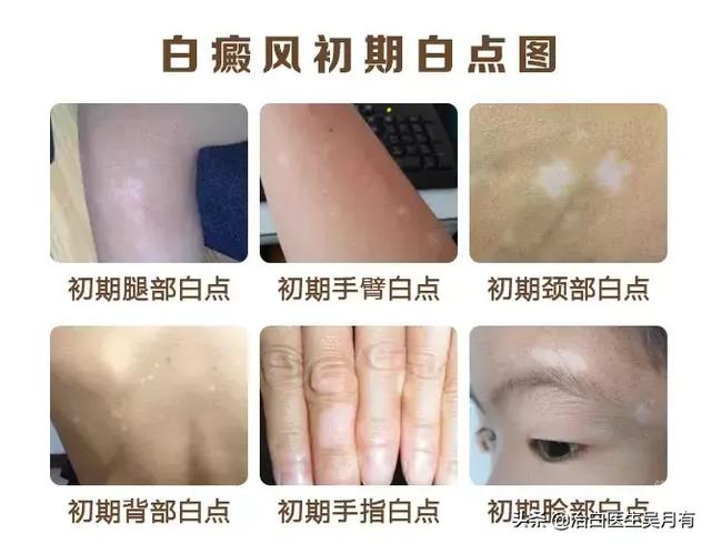 白斑會自己消失嗎（早期白斑有癥狀圖片能治好嗎）