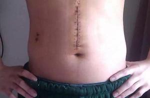 I get cancer of the stomach 26 years old, cut away