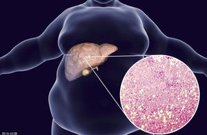 Fatty liver is very common, do not need treatment 