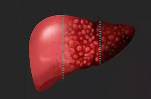 42 years old of men, perfunctory, fish liver cance