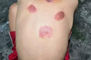 After 119 children stick three fit perfectly by burnable! Among them somebody has a fever 20 hours c