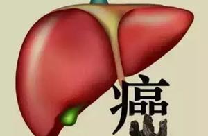 Meritorious service of liver of check-up of 38 years old of men is regular, liver cancer of the fish