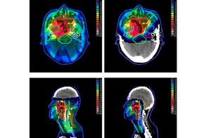 Odds of side effect of cancer proton therapy is re