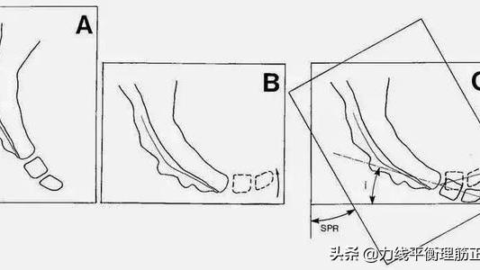 尾骨骨折要多久痊愈