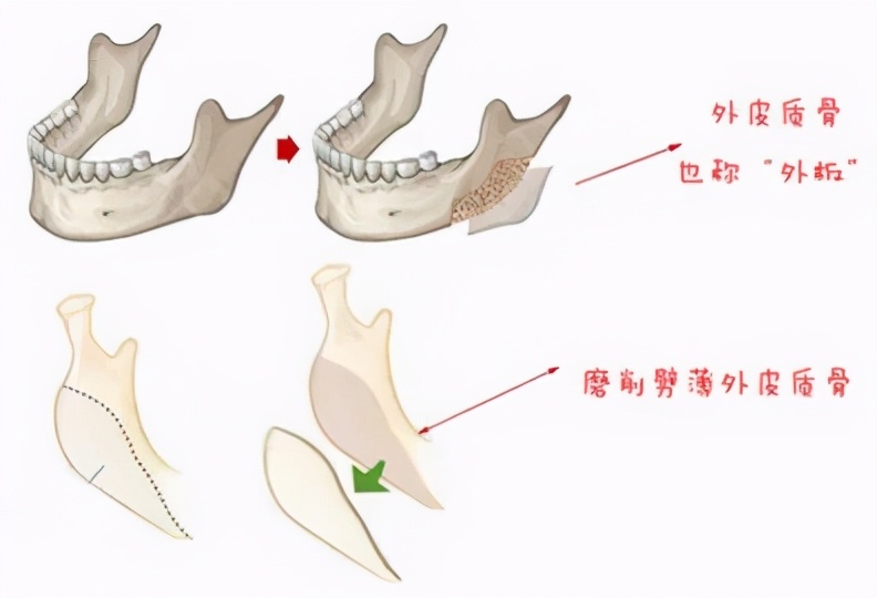 具体是在做下颌角截骨术,把四方脸的骨骼棱角予以缩小的同时进行皮质