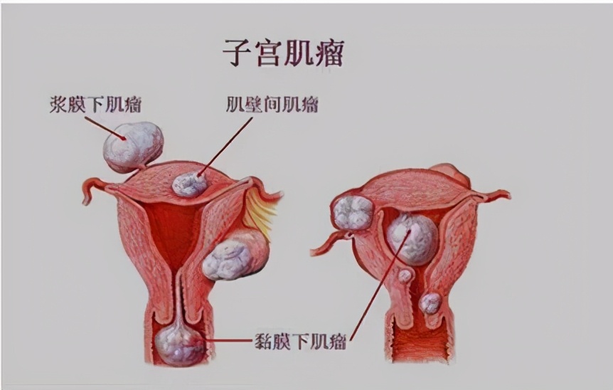 月经多经期长原来是子宫肌瘤惹的祸