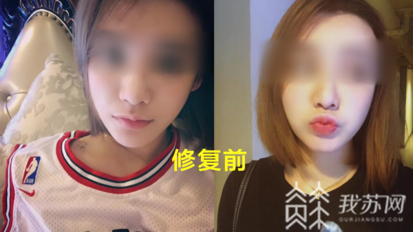 整形后成了“猪鼻子”整形医院：这是抽烟导致的