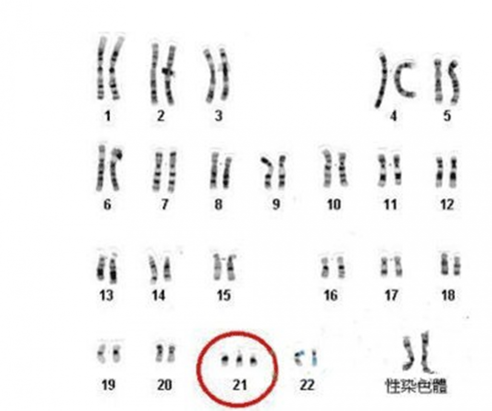 唐氏儿所患的疾病叫"唐氏综合征",也叫"21-三体综合征",是由于染色体