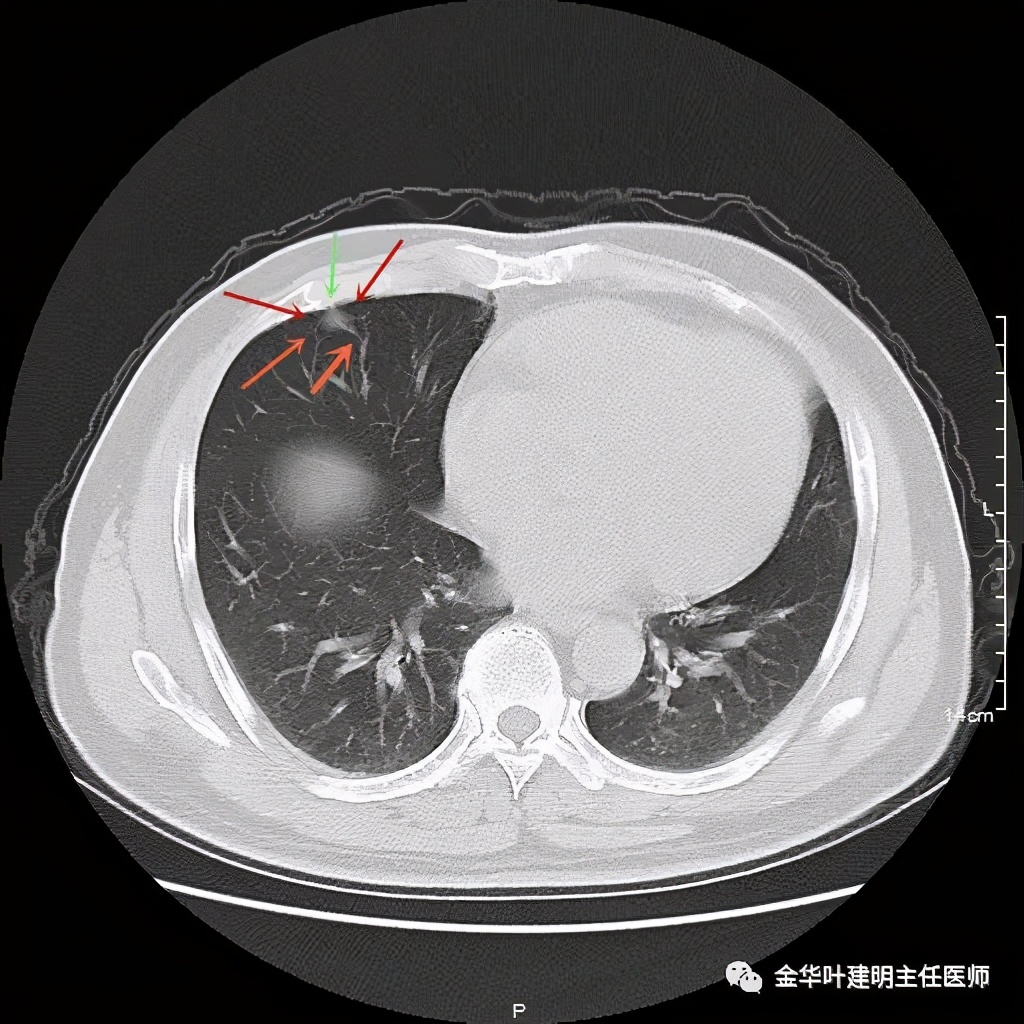 磨玻璃还伴血管穿行的肺结节真的是肺癌吗
