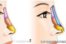 单纯隆鼻是什么，和综合隆鼻有什么区别?