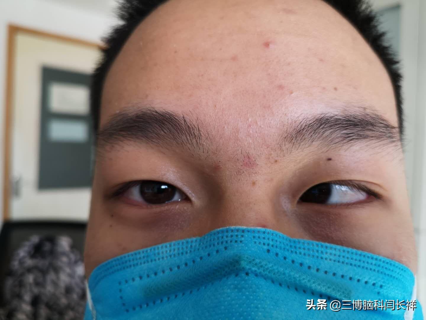 视物重影,斜视,不能只看眼科,神经外科也要看_复视_复视就诊指导 - 好